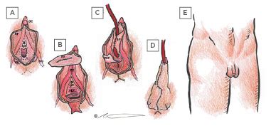 phalloplasty healed results|Phalloplasty: What is it, Risks, Benefits, Recovery.